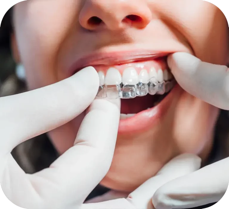 Clear Aligners including Invisalign