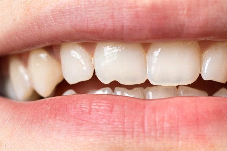 Are Chipped Teeth Ruining Your Smile? How Veneers Can Help
