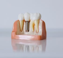 dental implant care