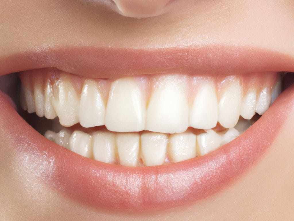 Teeth Whitening Special Northridge