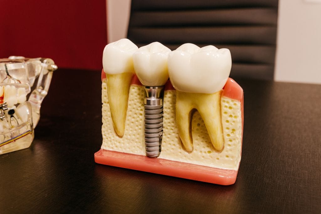 dental implant costs in Northridge