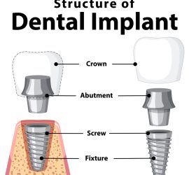 Structure of Dental Implant