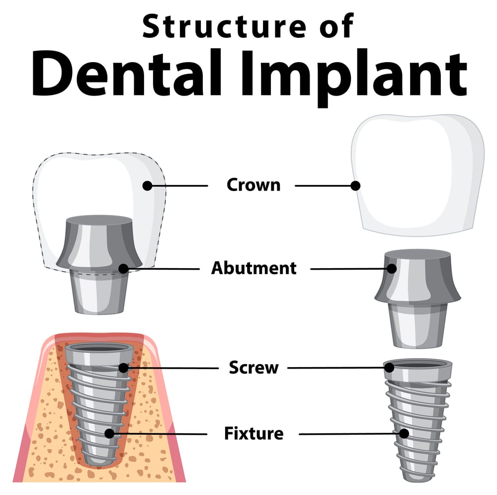 Structure of Dental Implant